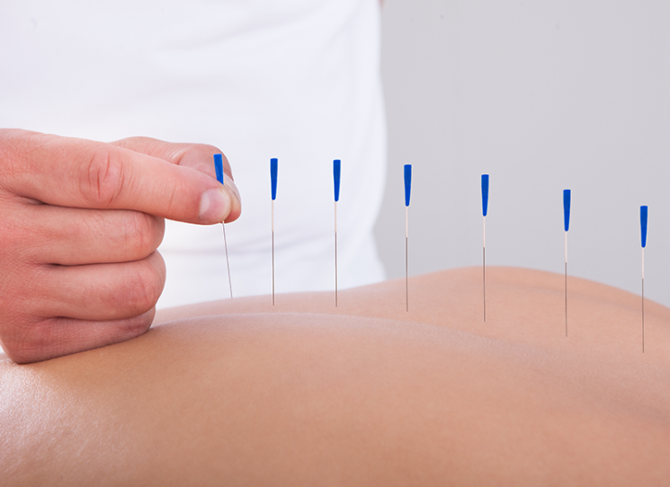 Why You Should Try Dry Needling Therapy Advanced Manual Therapy 0094