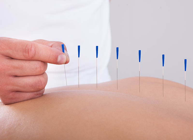 Dry Needling Therapy Blog Image